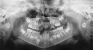 Dental Radiographs (X-Rays) - Pediatric Dentist in West Des Moines, IA