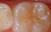Sealant-Before - Pediatric Dentist in West Des Moines, IA